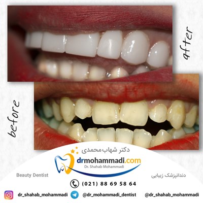 ونیر طرح لبخند